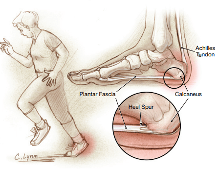 Fascite plantar: o que é, quais são os sintomas e como tratar figura_6-4163495